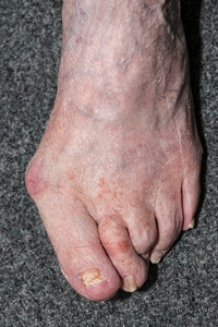 What Causes a Bunion to Form?