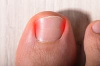 How Can I Tell if My Child Has Developed an Ingrown Toenail?